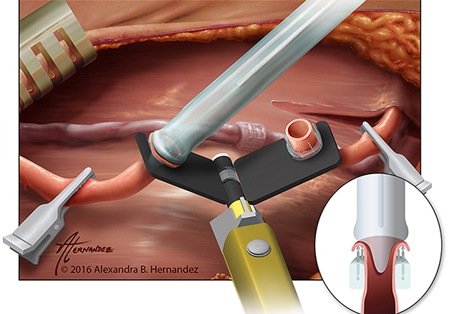 a 3d illustration of an arterial everter being used during surgery as a tool