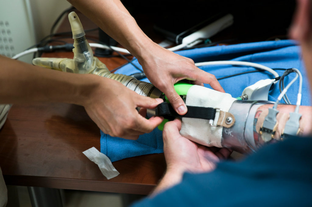 Attaching the prosthetic arm