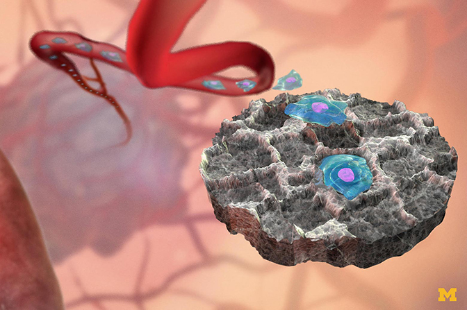 An illustration showing how an implantable device attract cancer cells