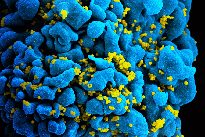 Scanning electromicrograph of an HIV-infected T cell.