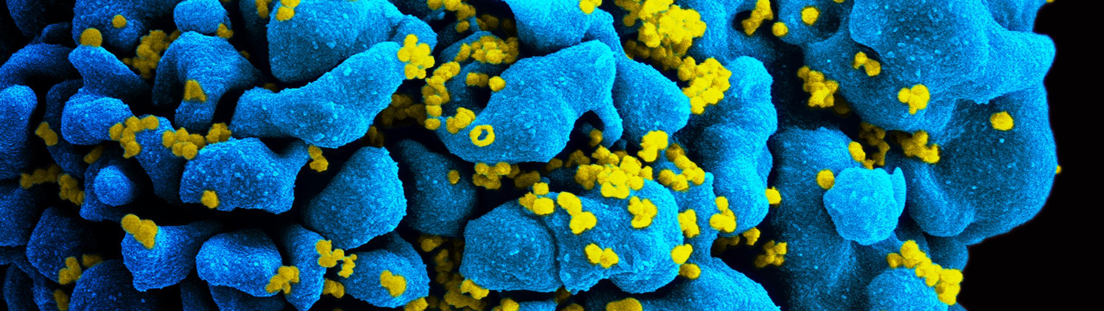 Scanning electromicrograph of an HIV-infected T cell