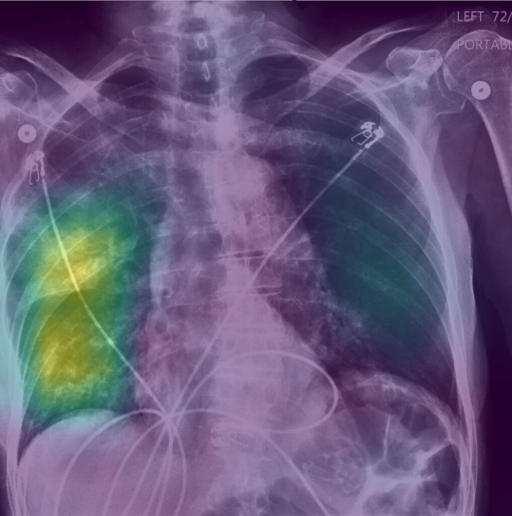 The collar bones, chest bones, and vertebrae of a patient stand out in light purple. The patient's left lung cavity is covered in a cloud of yellow that transitions to green and blue toward its edges. This highlighted area was marked as an important feature in the X-ray by the research team's AI model trained to be reasonably accurate.