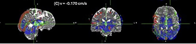 Three MRI scans of a brain in different views. In the leftmost scan from the side, a large red line traces from the back of the head up to the crown along the perimeter denoting the sagittal sinus. The center scan from the front view and right scan from below, large blue and green globules center around the brainstem denoting the cerebral aqueduct.