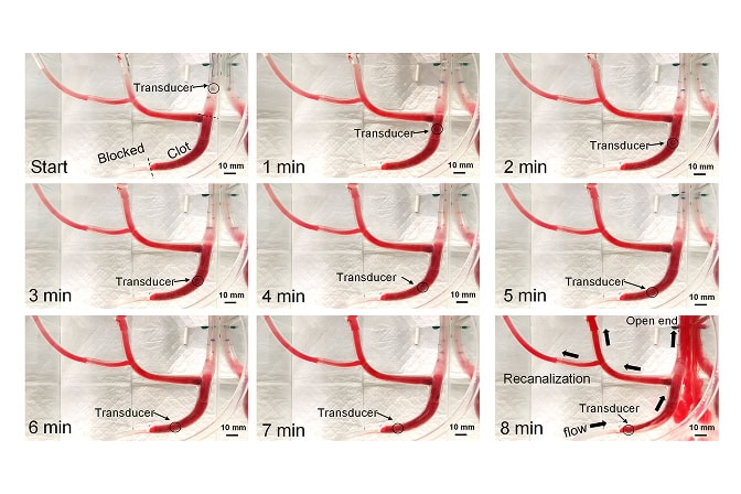 Treating life-threatening blood clots in minutes with swirling sound waves